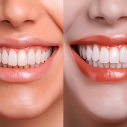 Professional vs. DIY Teeth Whitening