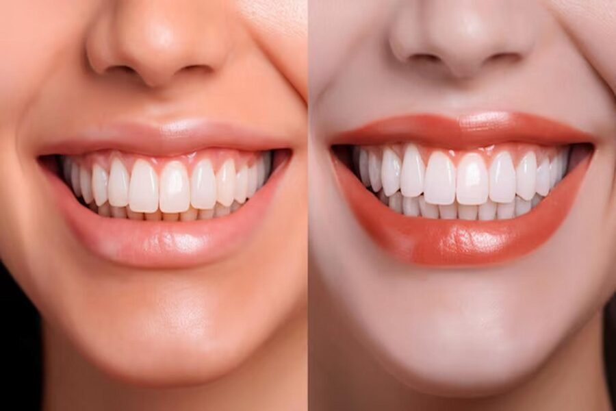 Professional vs. DIY Teeth Whitening